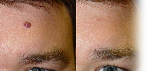 Ce sunt hemangioamele?