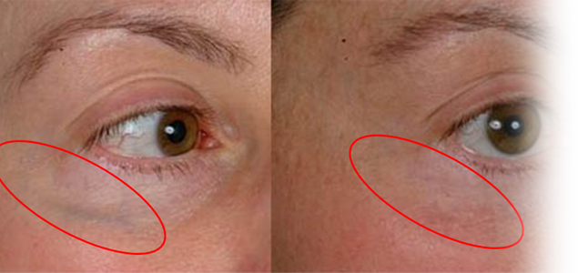 Cum arata un hemangiom?