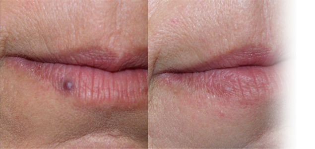 Cum se trateaza hemangioamele?