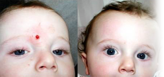 Cum poate evolua un hemangiom?