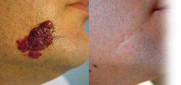 Diagnosticul de hemangiom